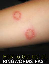 How To Get Rid Of Ringworms Fast Get Rid Of Ringworm How To Get Rid Herbalism