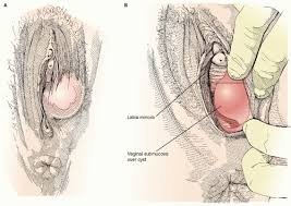 Image result for Bartholin's gland abscess