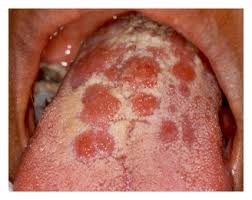 Each stage of syphilis presents a different set of signs and symptoms. Clinical Spectrum Of Oral Secondary Syphilis In Hiv Infected Patients