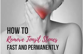 Check spelling or type a new query. How To Get Rid Of Tonsil Stones Fast And Permanently
