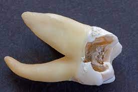 The combination of the ginger and cayenne is quite amazing to fight off the wisdom tooth infection symptoms. Wisdom Tooth Infection What To Lookout For Balsall Common Dental