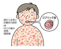 はしか（麻疹）｜原因・症状・対処法・予防法｜大正健康ナビ｜大正製薬 さん