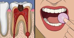 Wait 24 hours before rinsing your mouth with any liquids. 11 Effective Things You Can Do To Stop Wisdom Tooth Pain