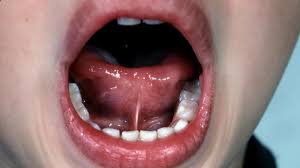 Sometimes, impediments in speech, like stuttering, grow from nerves and anxiety. Tongue Tie