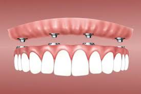 Image result for dental implant