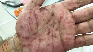 Image result for skin rash acute hiv infection