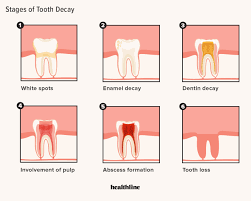 How to reverse tooth decay in babies. Tooth Decay Stages 5 Stages And How To Treat Each