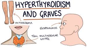 Graves' disease is the most common cause of hyperthyroidism, and is the result of the immune system producing antibodies to a protein on the thyroid gland that normally regulates the production of. Understanding Hyperthyroidism And Graves Disease Youtube