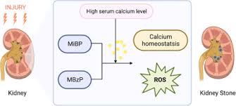 Image result for Calcium Nephrolithiasis