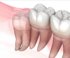 How do i relieve my wisdom tooth pain? Some Wisdom On Wisdom Teeth Lockhart Dentistry