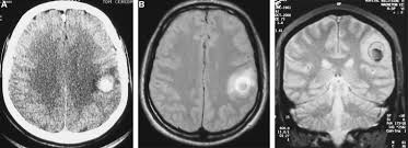 It generally occurs in people with lung diseases such as asthma, cystic fibrosis or tuberculosis, or those who have had a stem cell or organ transplant, and those who cannot fight infection because. Aspergillose Cerebrale Chez Le Sujet Immunocompetent A Propos De Trois Cas Sciencedirect