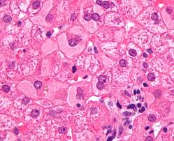 Hepatitis delta virus requires the envelope of the helper virus, hepatitis b virus (family hepadnaviridae), to produce infectious particles. Viral Hepatitis Wikipedia