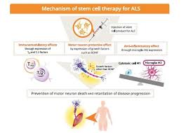 Amyotrophic lateral sclerosis (als) is a progressive neurodegenerative disease that affects nerve cells in the brain and the spinal cord. First Licensed Stem Cell Therapy For Als