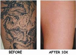 Before you begin to think of a laser as the magic wand of tattoo removal, you need to be aware that it's not a one and. How Laser Tattoo Removal Works At The Finery Times Square Chronicles