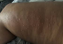 Maybe you would like to learn more about one of these? Skin Rash Should Be Considered As A Fourth Key Sign Of Covid 19