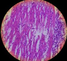 Generally accepted, due to the insensitivity of traditional diagnostic tests. Https Ispub Com Ijpa 13 2 13786