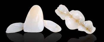 Entah karena dicabut, kecelakaan atau sebab yang lain. Apa Itu Maryland Bridge Dental Universe Indonesia