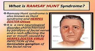 Compared with bell's palsy (facial paralysis without rash), patients with ramsay hunt syndrome often have more severe paralysis at onset and are less likely to recover completely. Download Free Medical Ramsay Hunt Syndrome Powerpoint Presentation