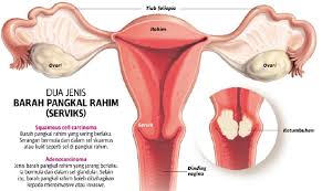 Diikuti 1 dos penggalak (booster) pada umur 15 bulan. Tahu Tak Kenapa Suntikan Hpv Penting Untuk Perempuan Yang Masih Bujang Remaja