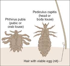 Image result for pubic lice symptoms