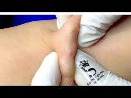 Relax Every Day With Sac Dep Spa 0200 Youtube In 2021 Zits Popping Pimple Popping Beauty Skin Care Routine
