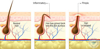 Ingrown chest hair ingrown hair is a condition where hair on the face or body curls back into the follicle or grows sideways into the skin. Laser Hair Removal For Ingrown Hairs
