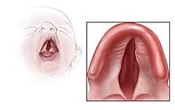 Bamforth–Lazarus syndrome - Wikipedia