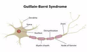 Typically, both sides of the body are involved. Study Finds No Significant Association Between Covid 19 And Guillain Barre Syndrome