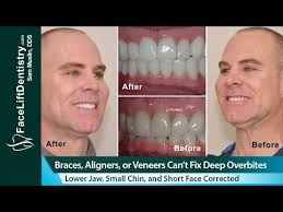 Jasmine naderi describes what an overbite is, and what ways there are to fix it. Overbite Fix No Braces No Aligners No Surgery 8 Days