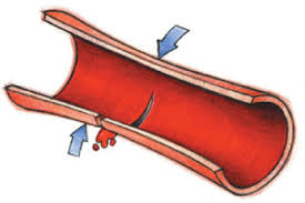 Anticoagulation is contraindicated in any localized or general physical condition or. Https Www Bk Trier De Media Bkt Docs Piz Piz Broschuere Leben Mit Gerinnungshemmern 2016 Pdf