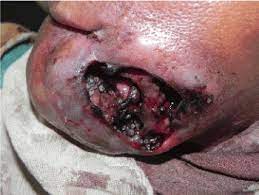 Certain species' larvae will move deeper in the body and cause severe damage. Maxillofacial Myiasis In A Malignant Ulcer Pouring Oil On Flame