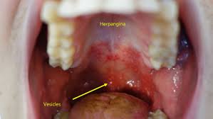Image result for Hand foot and mouth disease HFMD roof of mouth