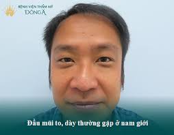 Có nên thu gọn đầu mũi? Thu gọn đầu mũi liệu có nguy hiểm?