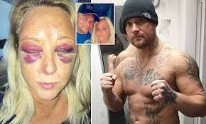 In bare knuckle boxing there are no gloves worn. Coventry Mother Reveals Horrifying Injuries From Boxer Ex Daily Mail Online