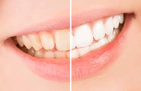 Coffee Stains Teeth What You Should Know Before Your Next Cup Newbury Dental Group