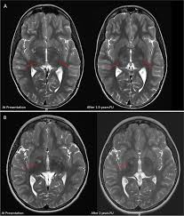 Image result for Incidental Imaging Finding