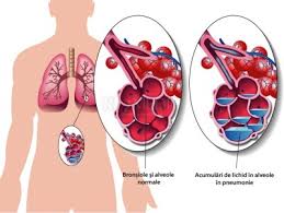 Pneumonia viral poate dura mai mult. Pneumonie