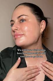 I had chin lipo TWICE to get rid of my double chin