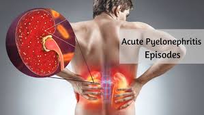 Image result for Acute Pyelonephritis