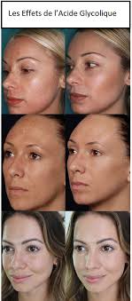 La Technique Du Peeling A L Acide Glycolique Est Decrite Comme Produisant Les Memes Effets Qu Un Coup De Soleil Peeling Visage Acide Glycolique Brulure Visage