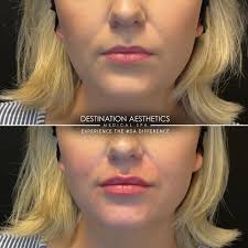 1 syringe of JUVÉDERM® VOLLURE®...