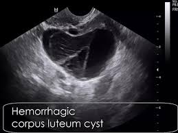 Image result for corpus luteum sonography)