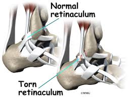 The most important part of the medial retinaculum is the medial. Peroneal Tendon Subluxation Eorthopod Com