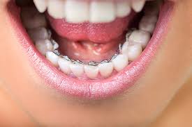 List of costs for clear braces: Types Of Braces Dalton Ga Orthodontics Clear Braces