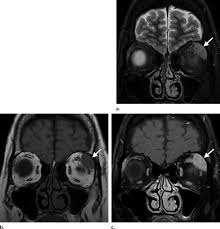 Image result for Dacryoadenitis