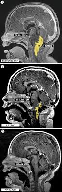 How to check for brain tumor. Son S Brain Tumor Diagnosis Propels Editor To Frontiers Of Medicine