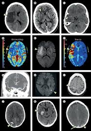 Stroke The Lancet
