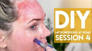 Microneedling treatment pre and post information microneedling is a safe, natural, alternative for resurfacing of the skin using microneedles to produce better skin texture, rejuvenate the skin, and assist in reducing fine lines and wrinkles. Microneedling At Home 4 Months Results Dr Pen A6 Before And After Youtube