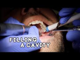 When your child closes their mouth and their upper and lower teeth settle in together, it may cause them pain. How Does A Dentist Fill A Cavity Youtube