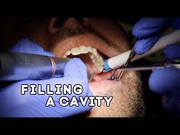 Asking about tooth pain and sensitivity 2. How Does A Dentist Fill A Cavity Youtube